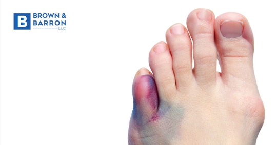 A foot with an injured toe is black and blue