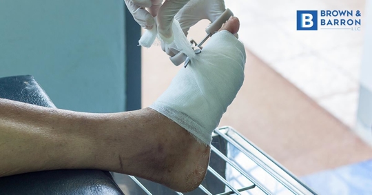 A diabetic foot ulcer is treated by a doctor