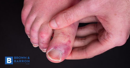 An injured toe. Podiatry malpractice in Maryland