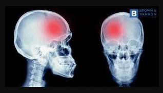 X-Ray of brain showing stroke