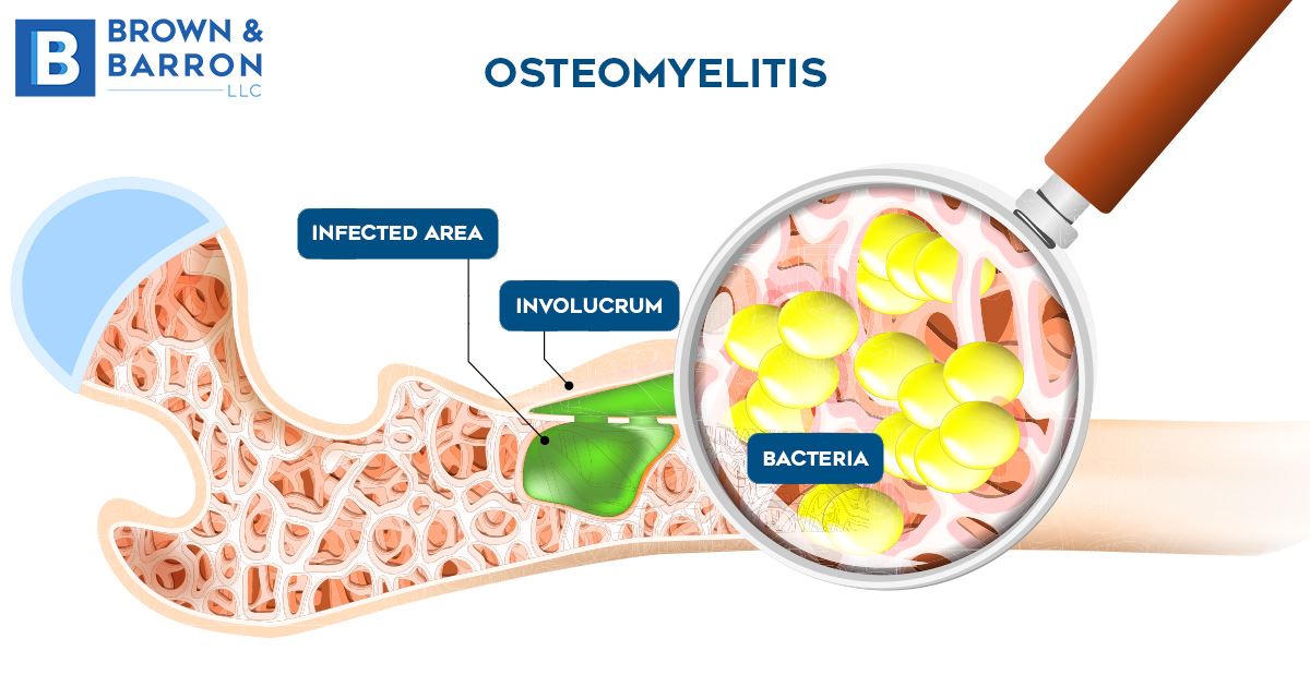 Understanding Osteomyelitis
