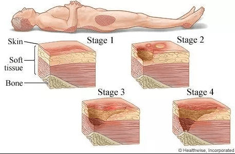 Stages Of Bedsores